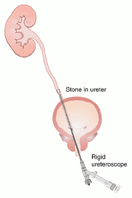 pcnl surgery